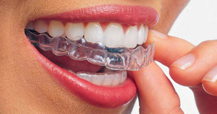 Apparecchio denti trasparente Invisalign