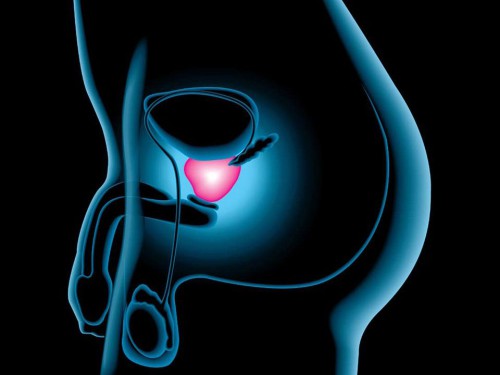 prostata tumore integratori