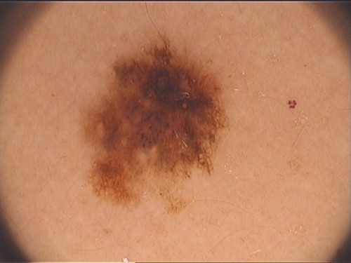 tumori della pelle