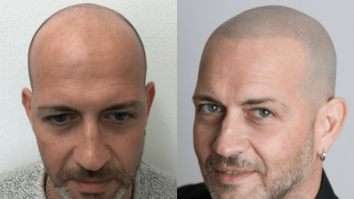 Tricopigmentazione vs Trapianto capelli vs Tatuaggio (e perché sceglierai la prima)