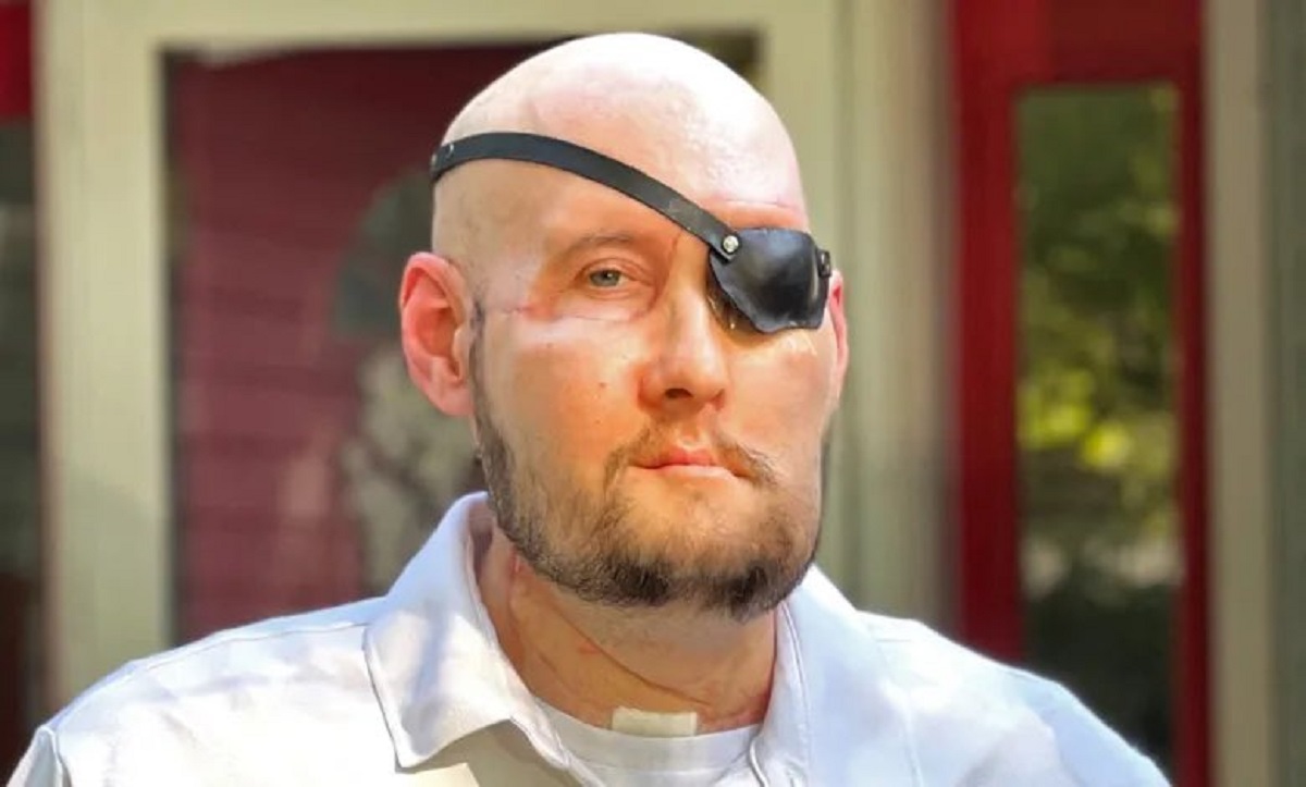 Eseguito il primo trapianto al mondo di bulbo oculare e del viso parziale, ottimo successo