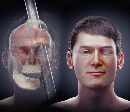 Lesione di Phineas Gage