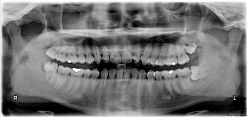 wisdom-teeth-m-1.jpg