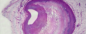 CrossSectionOfCoronaryArteryAtherosclerosis.jpg