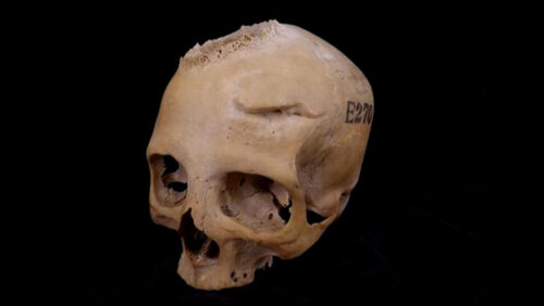 Documentato un intervento chirurgico di 4.000 anni fa per la cura del cancro
