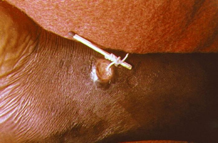 guinea-worm-removal-m-1.jpg