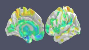 Identificata nuova sindrome che causa perdita di memoria spesso confusa con l’Alzheimer