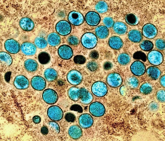 immagine microscopica elettronica a trasmissione colorizzata di particelle di virus mpox (turchese), che sono state trovate all'interno di una cellula infetta (marrone), coltivate in laboratorio. 