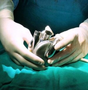 photograph-of-the-shiny-titanium-bivacor-total-artificial-heart-grasped-by-two-white-latex-gloved-hands-resting-on-a-turquoise-sheet-m.jpg