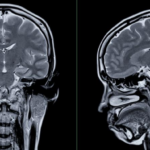 La Straordinaria Plasticità Cerebrale: Storie di Adattamento e Resilienza