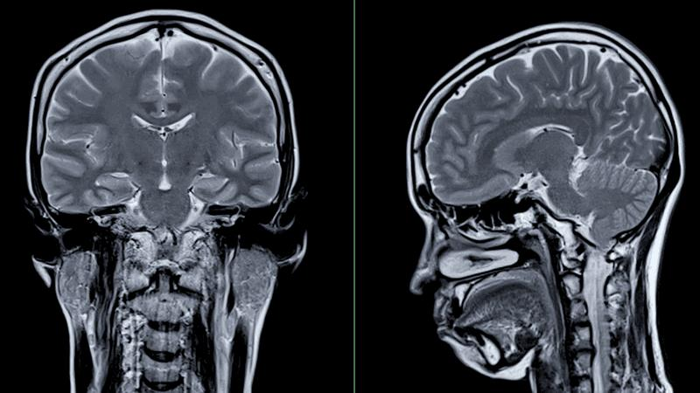 Risonanza magnetica del cervello da dietro e di lato