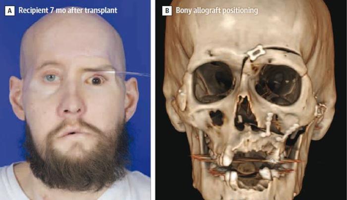 destinatario di trapianto di occhi e viso fotografato 7 mesi dopo l'intervento; il pannello destro mostra la scansione 3D del cranio per dimostrare il posizionamento dell'allograft osseo