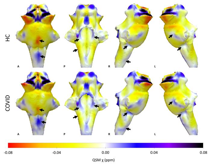 Proiezioni in 3D delle mappe X QSM sul tronco cerebrale reso estratto dalla segmentazione FreeSurfer per il gruppo di controllo sano e il gruppo COVID. Il gruppo COVID mostra un aumento di X nel tronco cerebrale, specificamente nella Medulla e nel Pons (frecce nere).