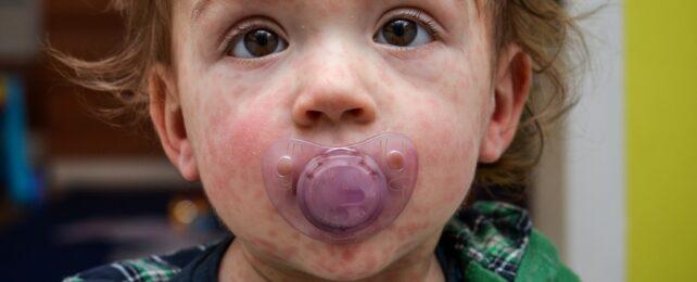 Uno primo piano del viso di un bambino con il morbillo