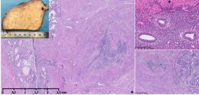 Aspetto macroscopico e microscopico dell'adenomiosi