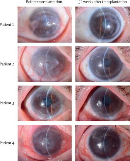 Radical Stem Cell Transplant Reverses Severe Vision Loss in Multiple People