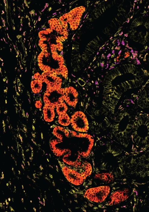 Imaging del tessuto intestinale umano nella malattia infiammatoria intestinale che mostra la presenza di ghiandole epiteliali metaplastiche.