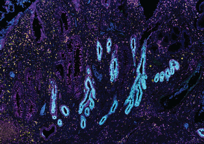 Imaging del tessuto intestinale umano nella malattia infiammatoria intestinale che mostra la presenza di ghiandole epiteliali metaplastiche.