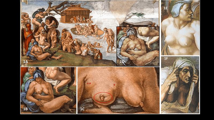 La rappresentazione di Michelangelo del Diluvio (1a), e una donna (1b e 1d) con un seno che mostra sintomi di cancro 1c. Altri lavori mostrano che Michelangelo sapeva come rappresentare seni sani (1e e f)