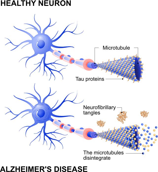 diagramma dei grovigli di tau nel cervello