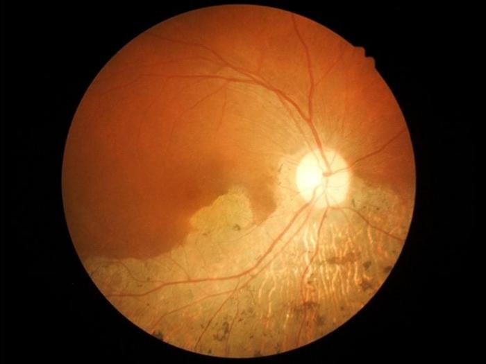 Age-Related-Macular-Degeneration-777x583-1.jpg