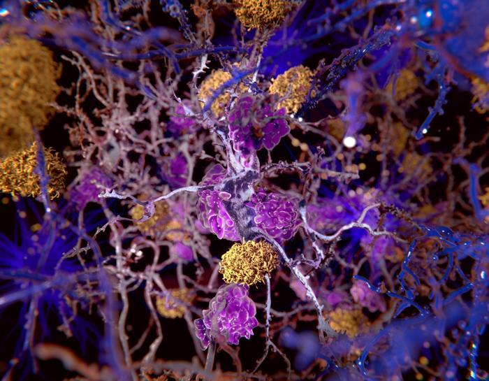 Grumi di giallo che si formano tra i neuroni viola