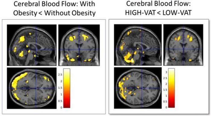 Flusso sanguigno cerebrale e obesità