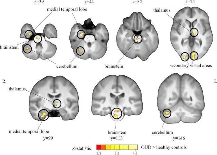 Analisi della distribuzione della connettività intrinseca delle scansioni fMRI di cervelli sani e con disturbo da uso di oppiacei