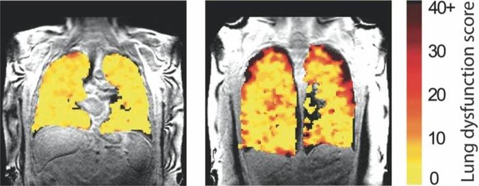 Lung Function MRI