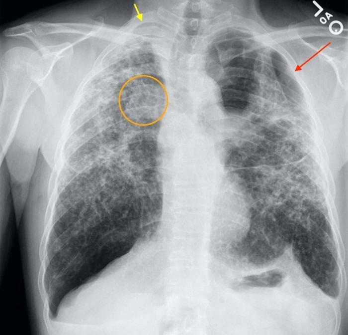 Radiografia del torace per silicosi