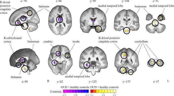 Analisi TBM delle scansioni MRI di cervelli sani e con DUA