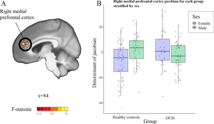 Analisi TBM del cervello con disturbo da uso di oppiacei MRI e box plot