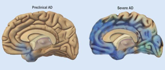 restringimento di Brian nella malattia di Alzheimer