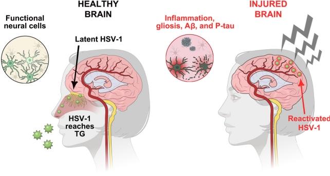 Lesioni Cerebrali Lievi Ma Croniche Possono Risvegliare il Virus dell'Herpes Semplice