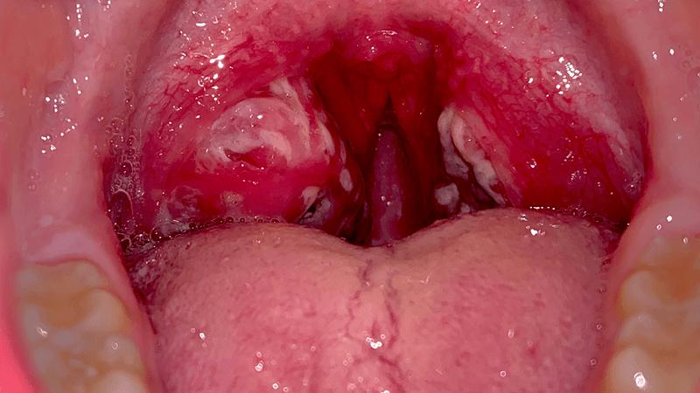 tonsils-m-1.png